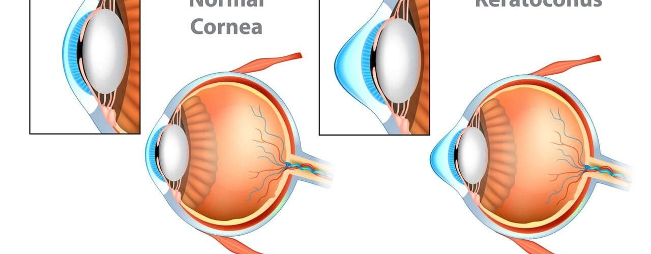 Une cornée normale versus kératoconique