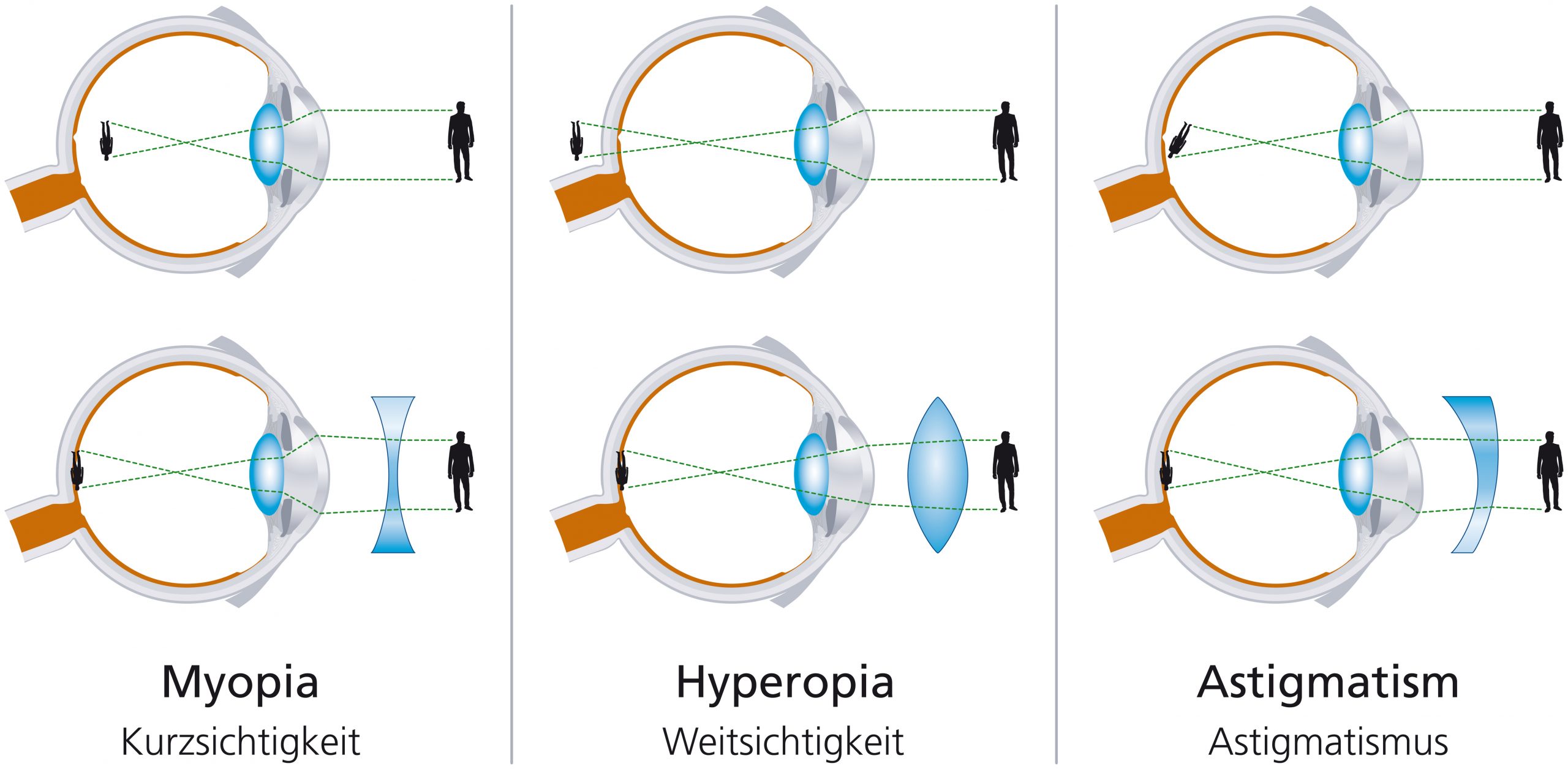 Jelentése myopia és hyperopia szemüveg